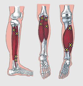 Common Trigger Points of the Lower Limb